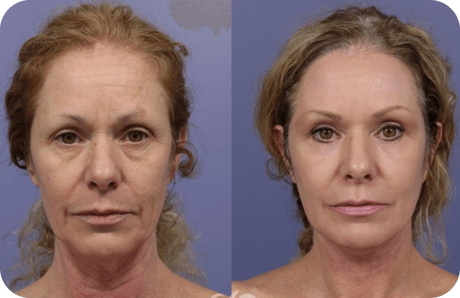 Synevra UltraLift Results